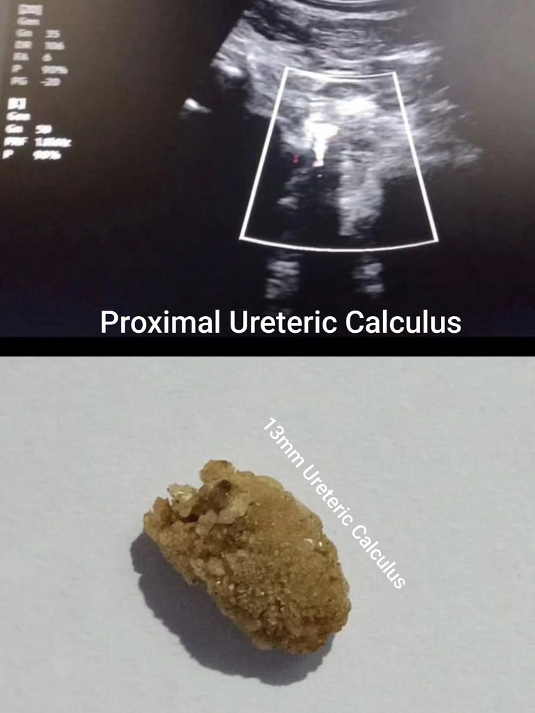 Proximal Ureteric Calculus