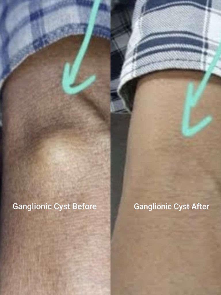 Ganglionic Cyst